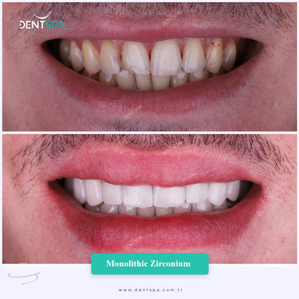 DENTSPA ISTANBUL ZIRCONIUM CROWNS 14