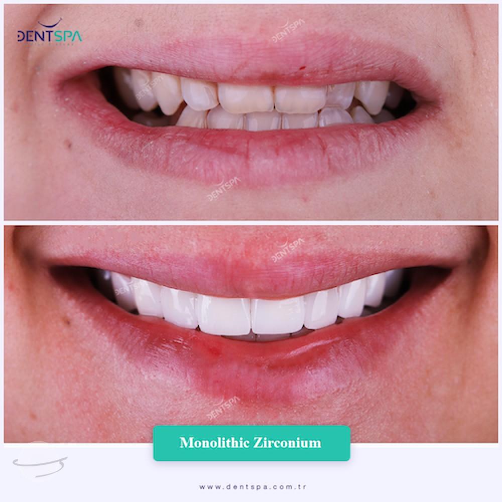 DENTSPA ISTANBUL ZIRCONIUM CROWNS 16