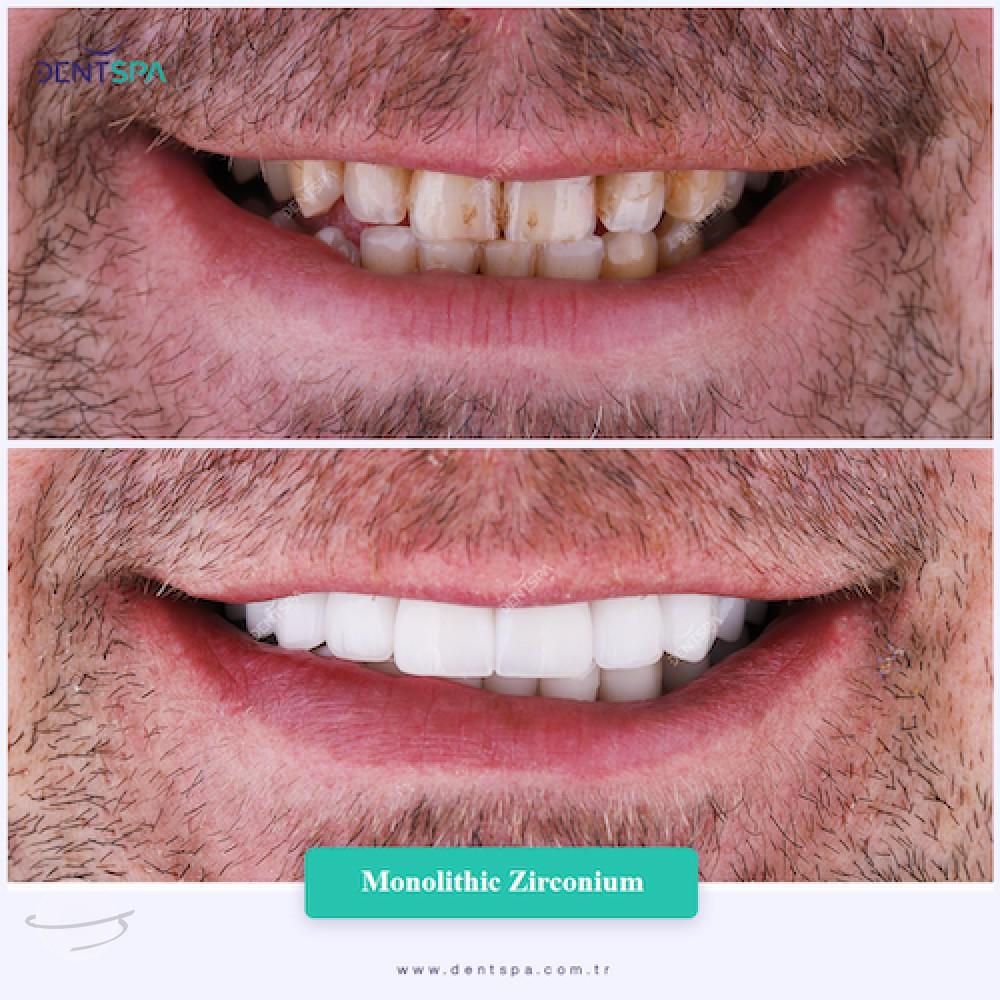 DENTSPA ISTANBUL ZIRCONIUM CROWNS 17