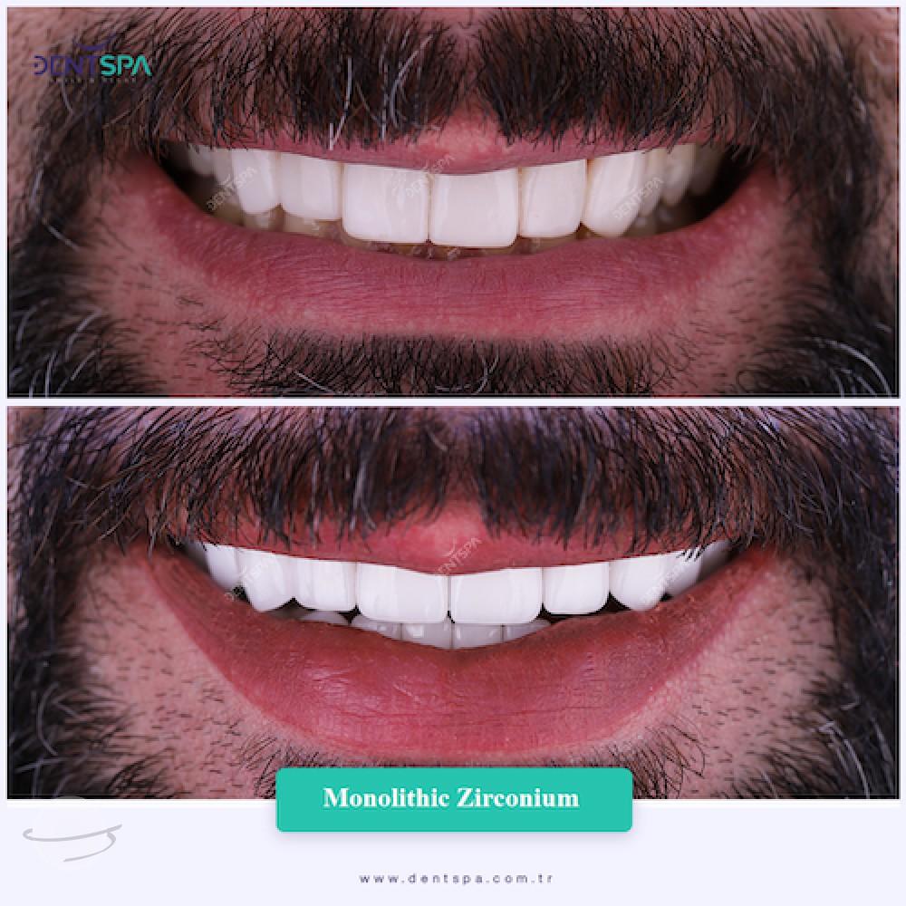 DENTSPA ISTANBUL ZIRCONIUM CROWNS 18