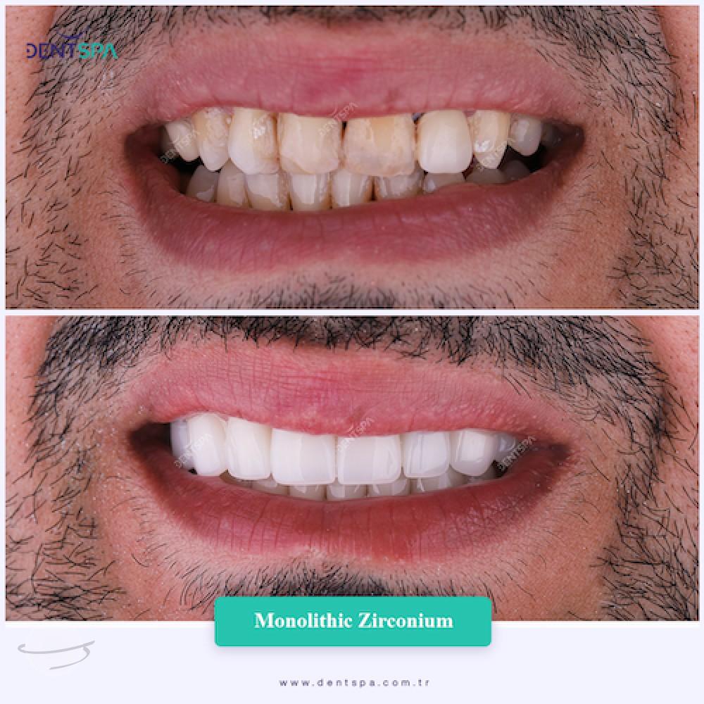 DENTSPA ISTANBUL ZIRCONIUM CROWNS 19