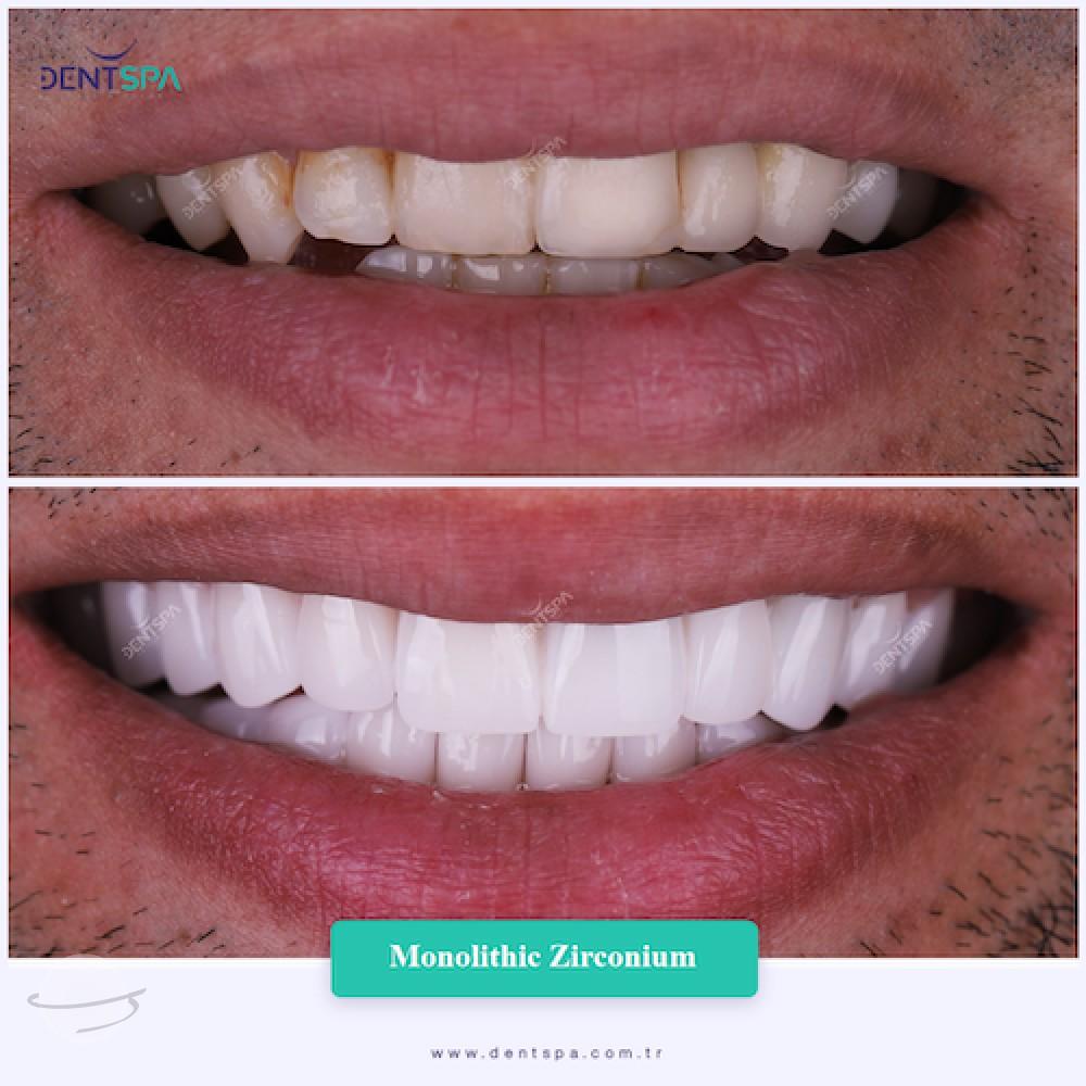 DENTSPA ISTANBUL ZIRCONIUM CROWNS 22