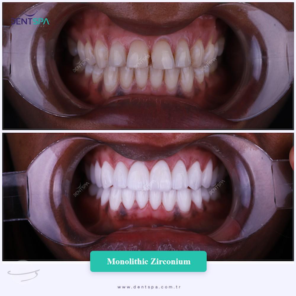 DENTSPA ISTANBUL ZIRCONIUM CROWNS 24