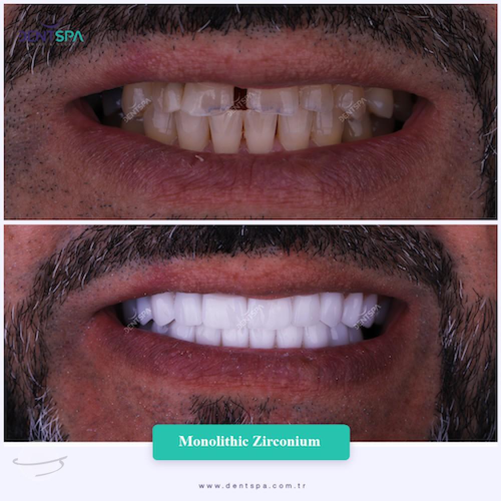 DENTSPA ISTANBUL ZIRCONIUM CROWNS 25
