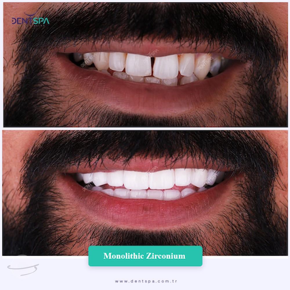 DENTSPA ISTANBUL ZIRCONIUM CROWNS 26