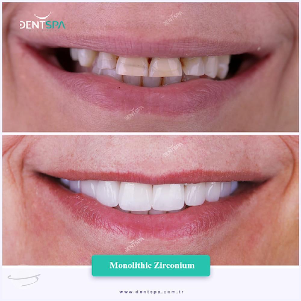 DENTSPA ISTANBUL ZIRCONIUM CROWNS 27