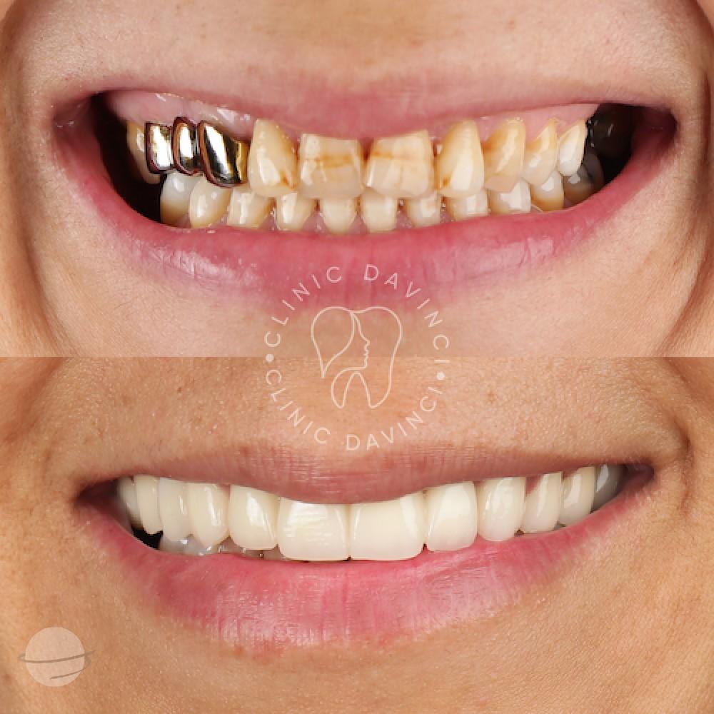 Da Vinci hollywood smiles6