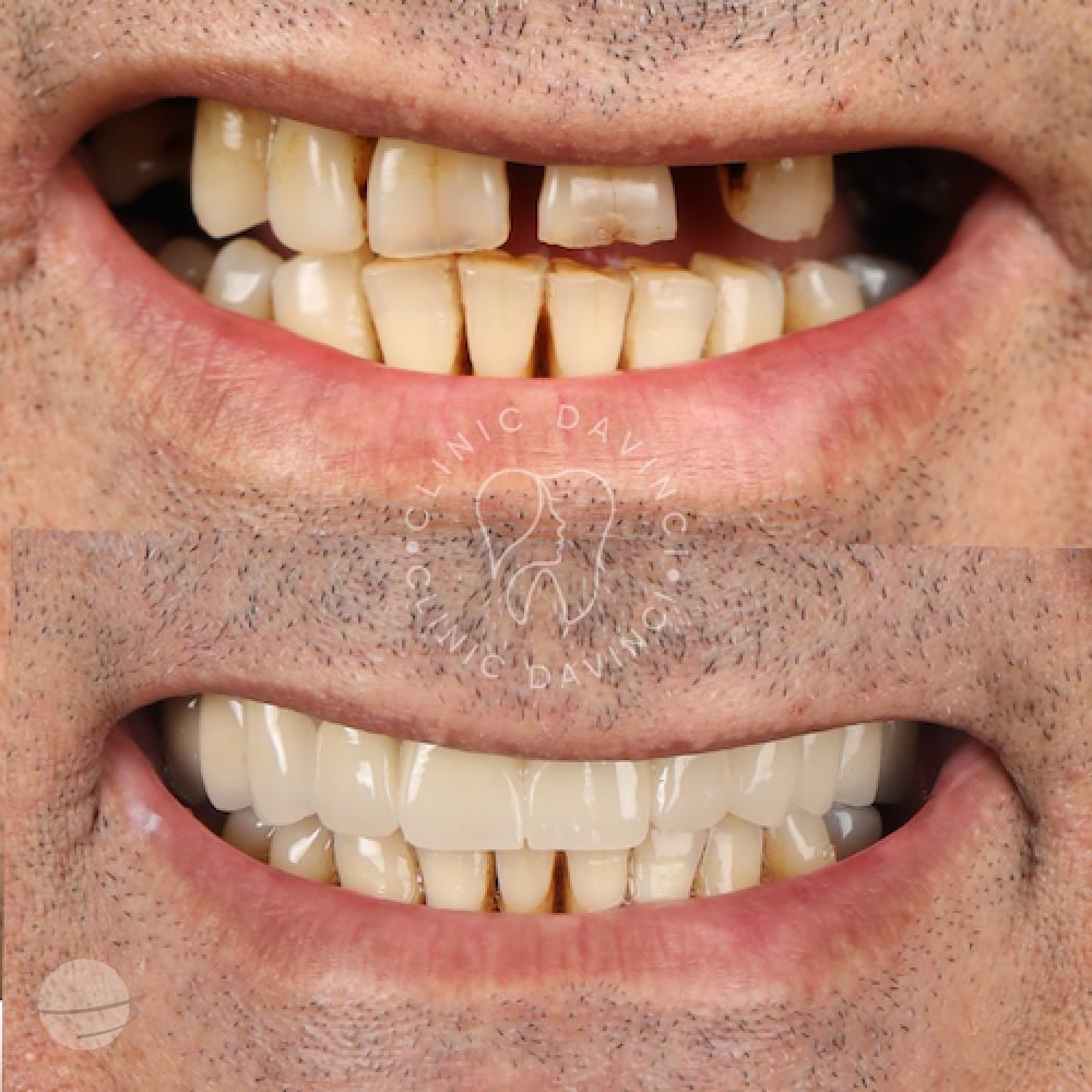 Da Vinci hollywood smiles5