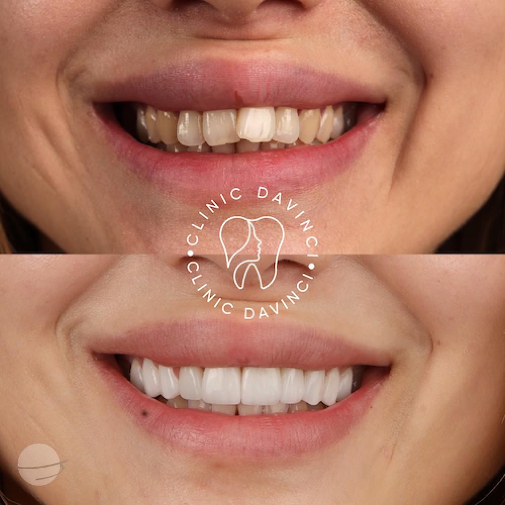 Da Vinci hollywood smiles9