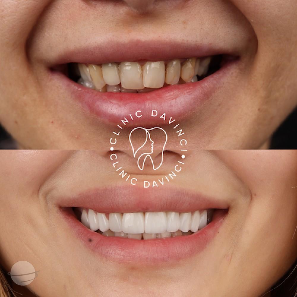 Da Vinci hollywood smiles1