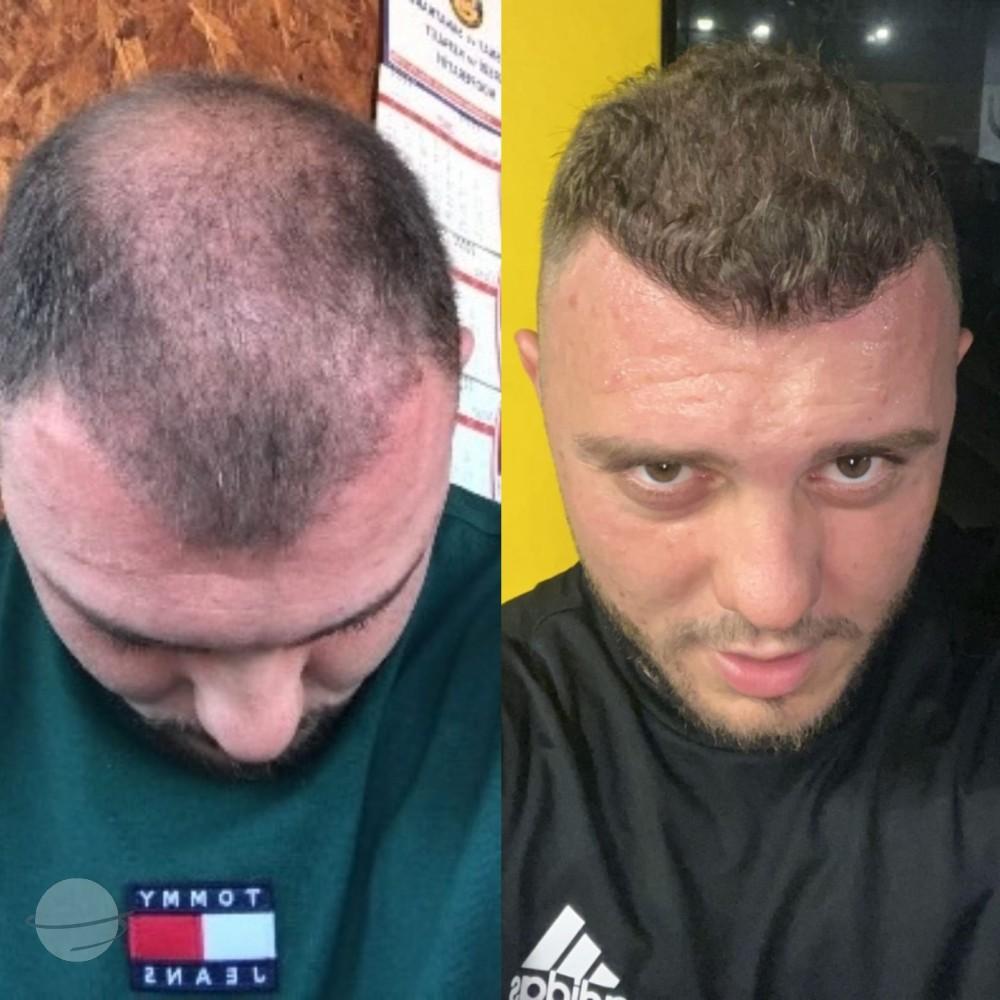 Hope Hair Health Resultats 3