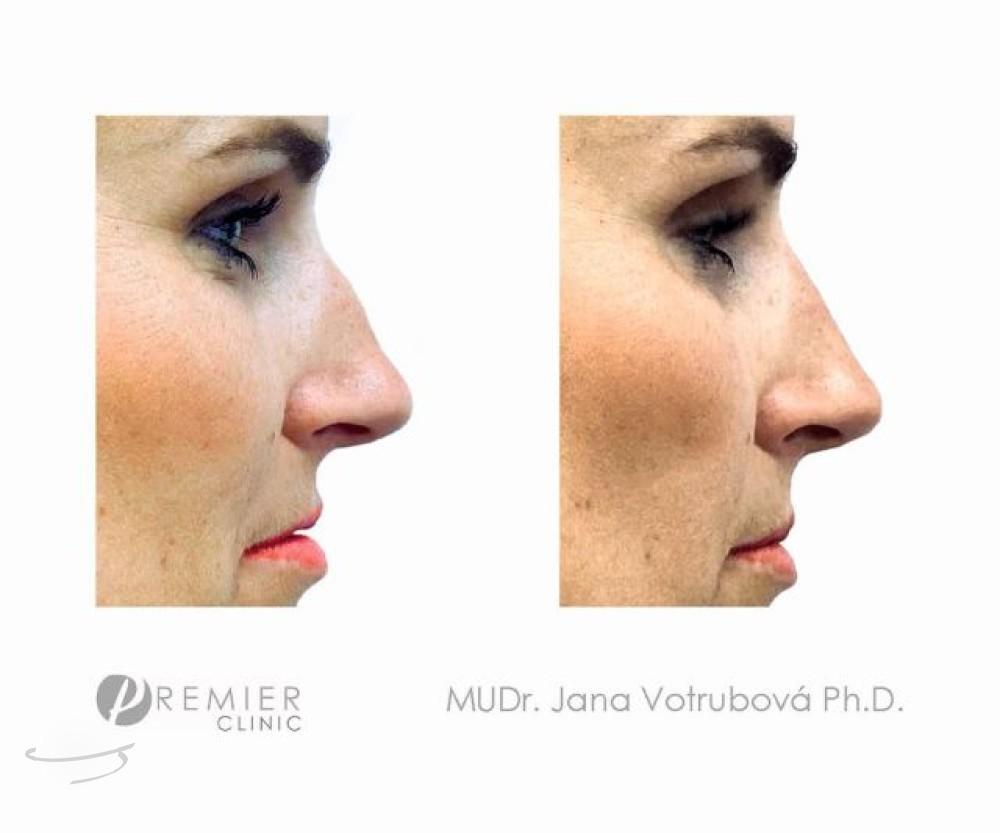 Rhinoplasty by Premier Clinic