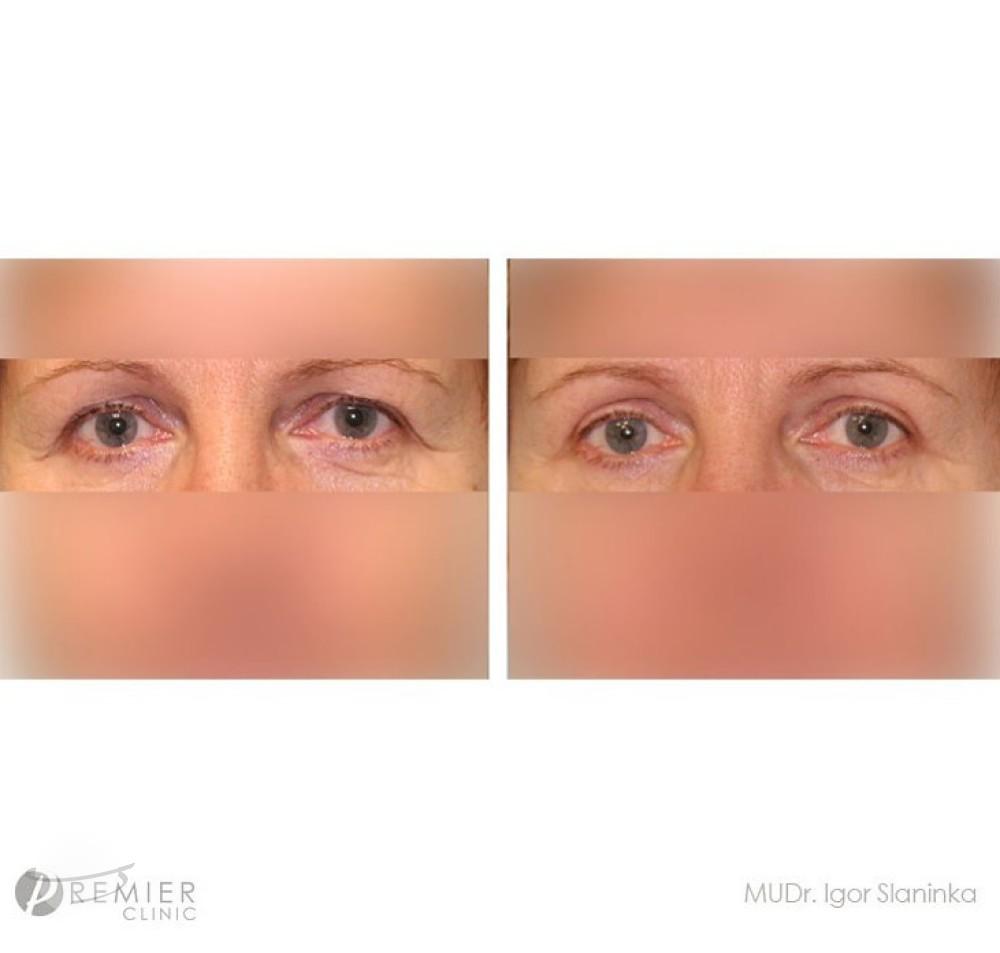 blepharoplasty by Premier Clinic