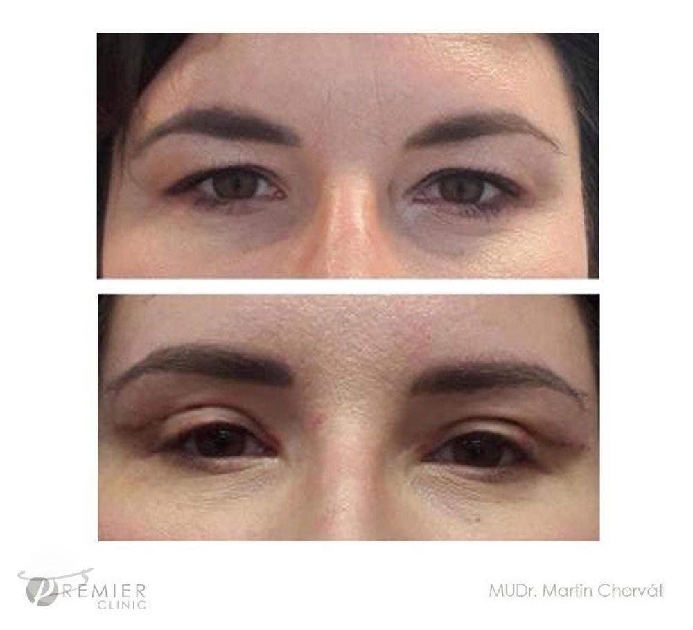 blepharoplasty by Premier Clinic