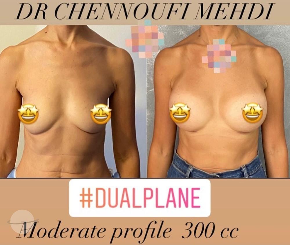 Breast Augmentation Mehdi Chennoufi 4