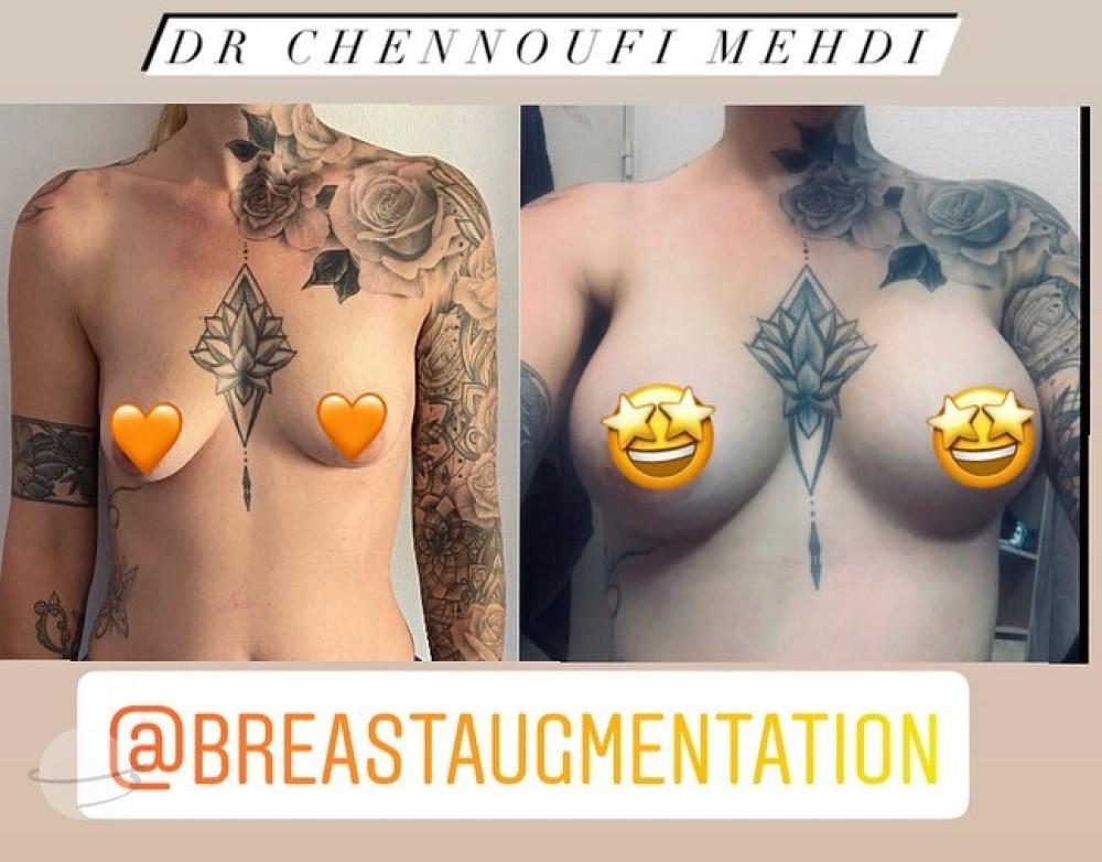 Breast Augmentation Mehdi Chennoufi 3