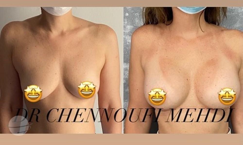 Breast Augmentation Mehdi Chennoufi 2