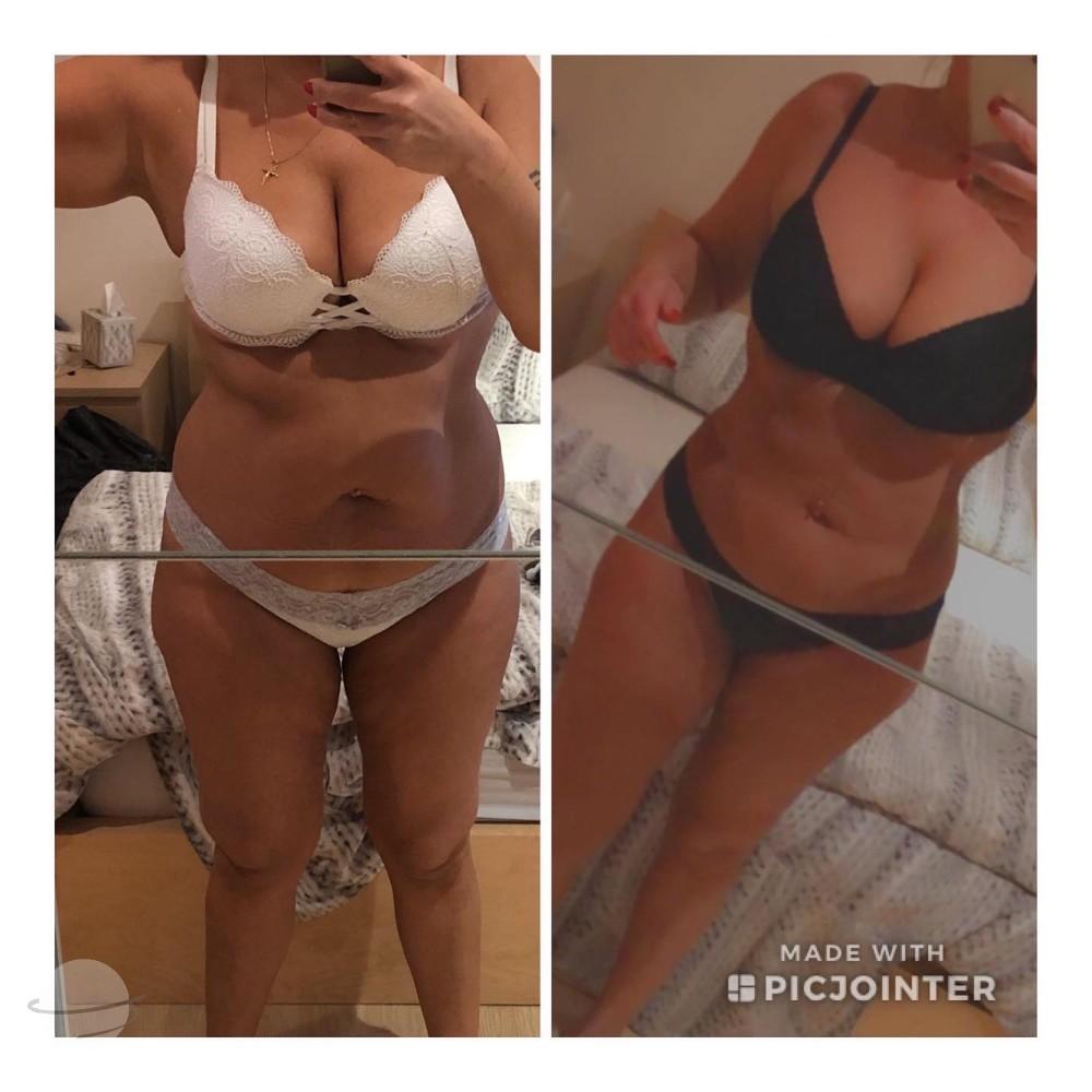 Liposuccion by Dr Chennoufi