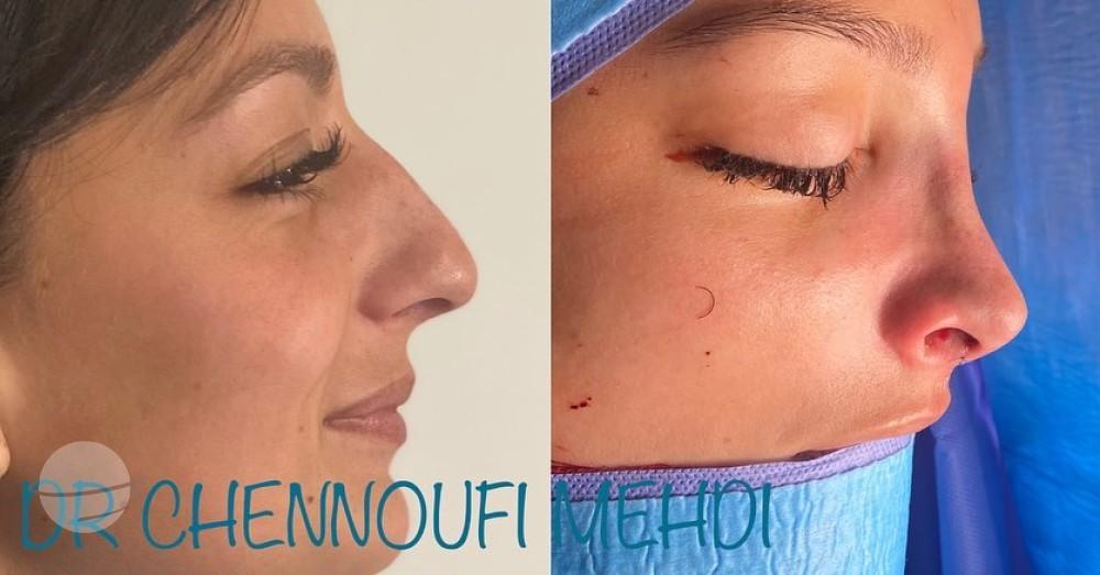 Rhinoplasy Mehdi Chennoufi 1