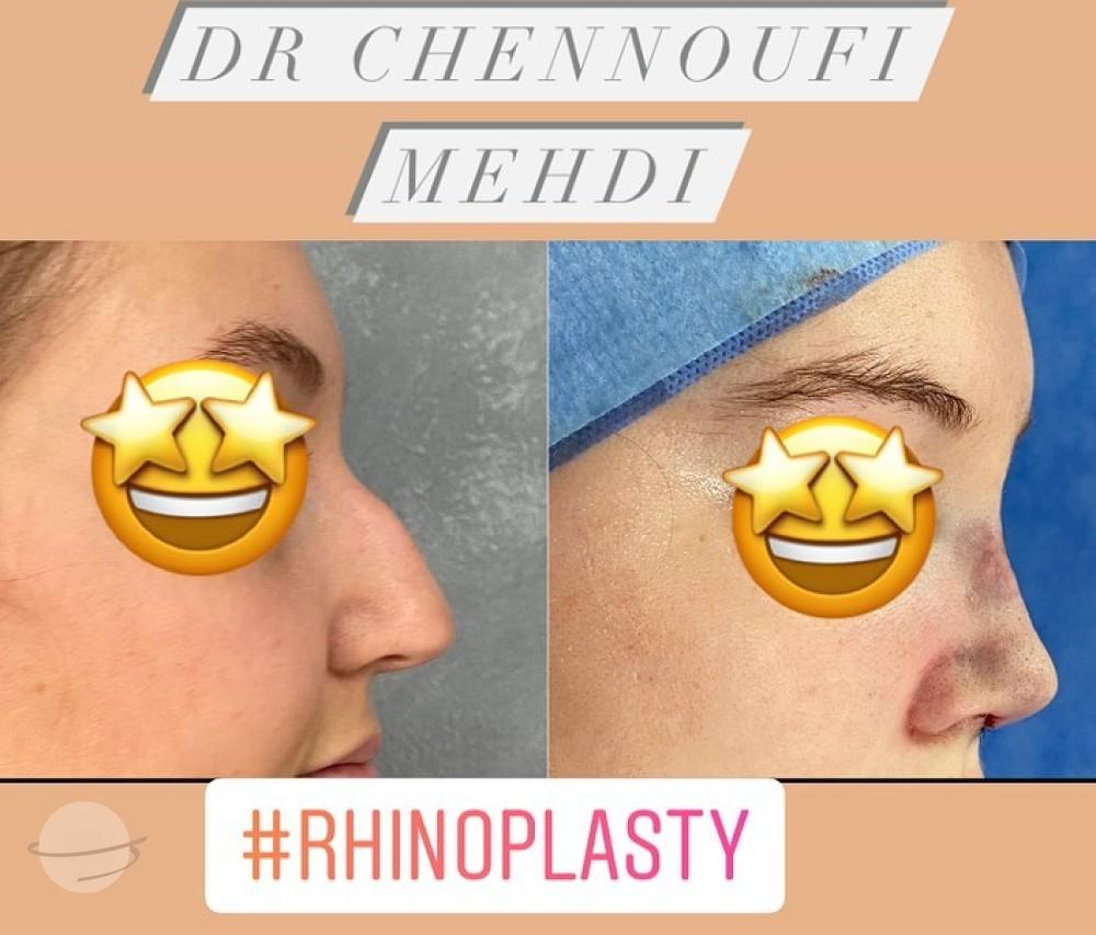 Rhinoplasy Mehdi Chennoufi 2