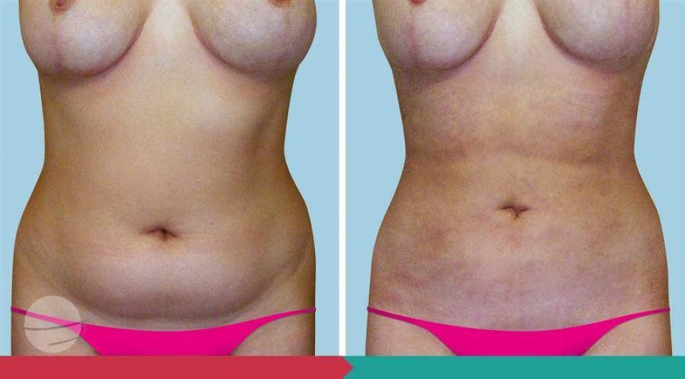 Liposuction ABClinic Praha6