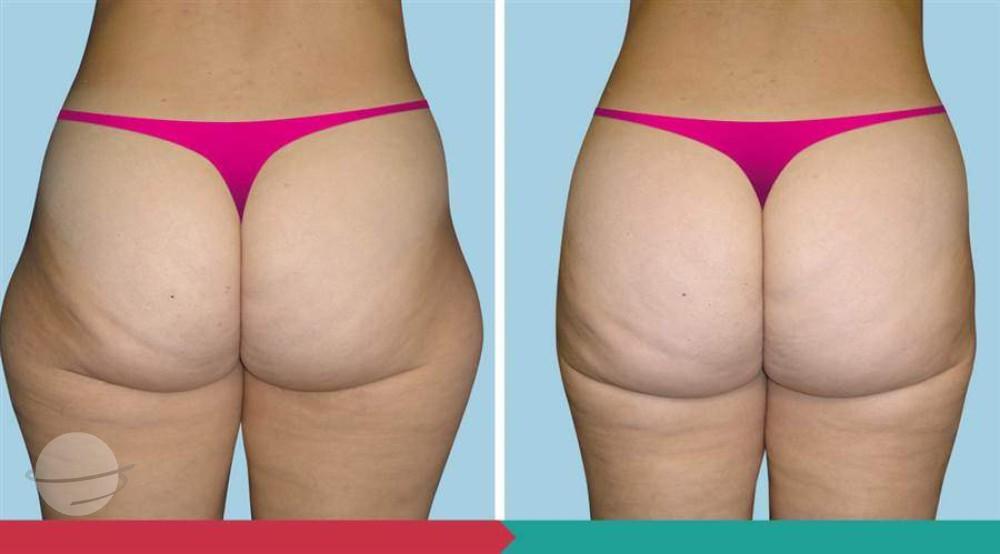 Liposuction ABClinic Praha10