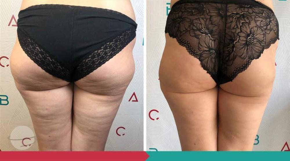 Liposuction ABClinic Praha12