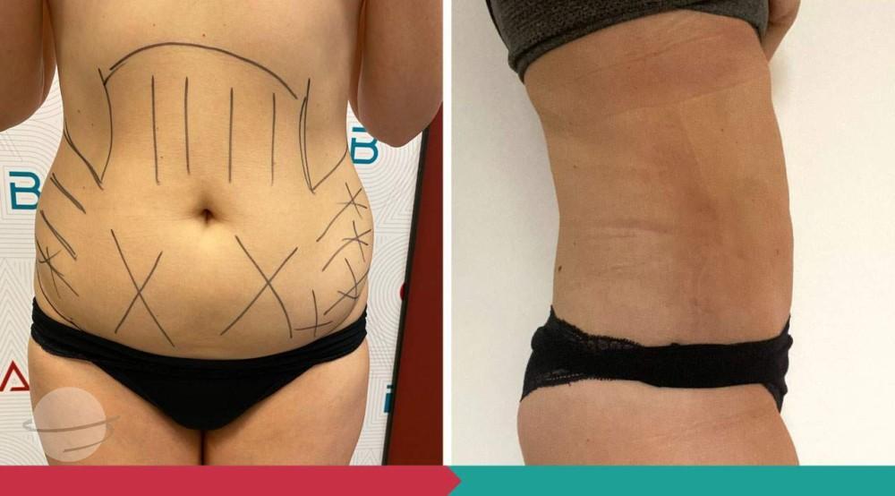 Liposuction ABClinic Praha15