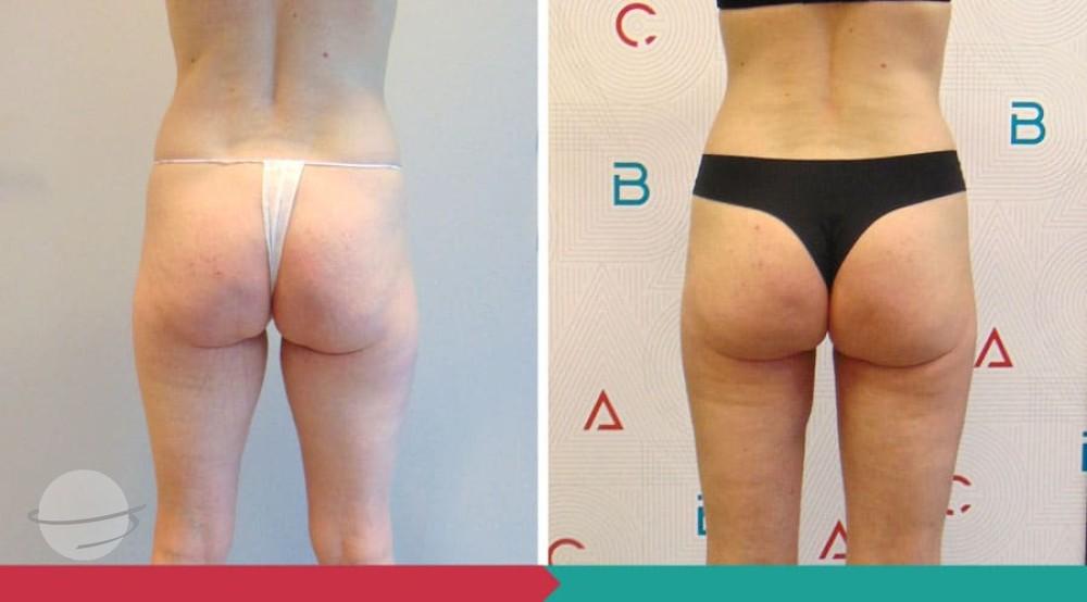 Liposuction ABClinic Praha18