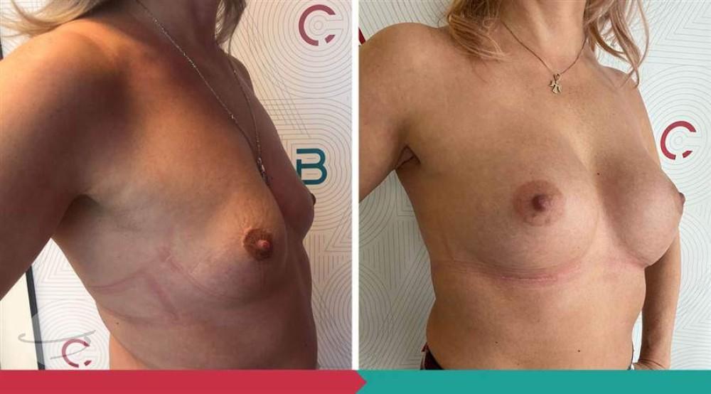 Breast Augmentation ABClinic Praha9