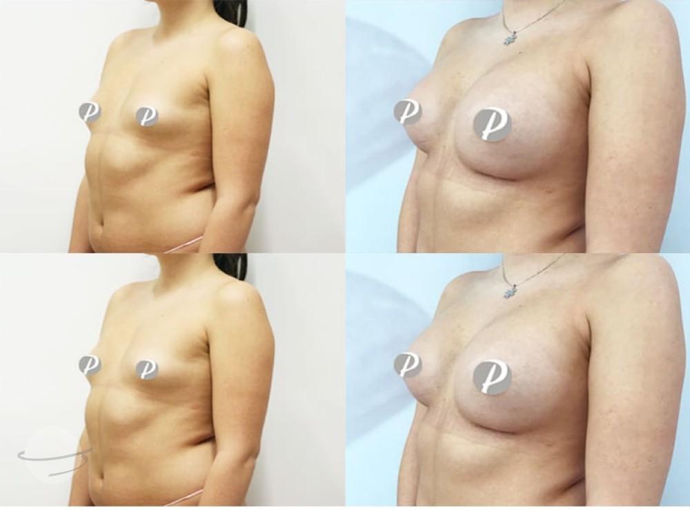 breastaugmentation-4-min