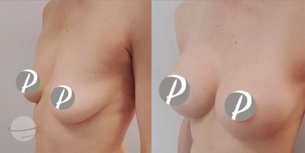 breastaugmentation-5-min
