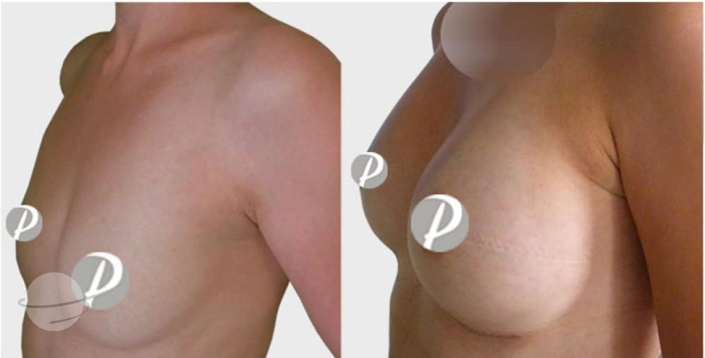 breastaugmentation-6-min