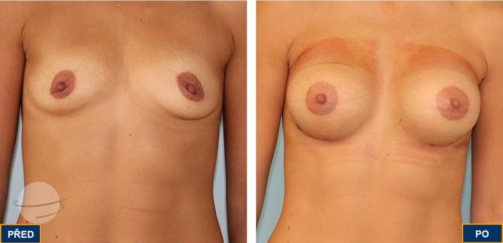 Breast Augmentation by Premier Clinic