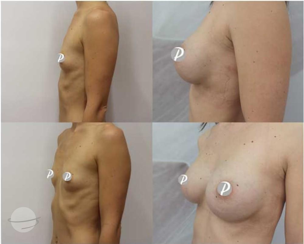 Breast Augmentation by Premier Clinic