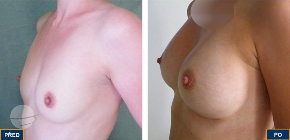 Breast Augmentation by Premier Clinic
