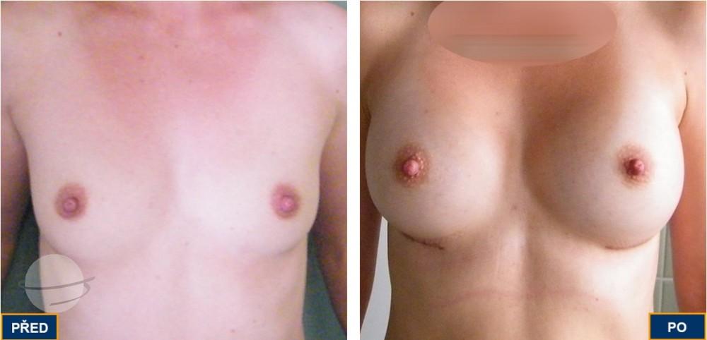 Breast Augmentation by Premier Clinic