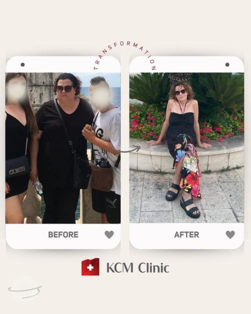 Weightloss at KCM clinic