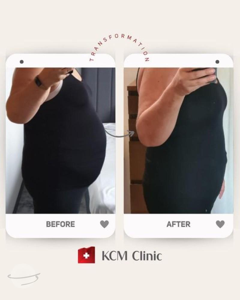 Weightloss at KCM clinic