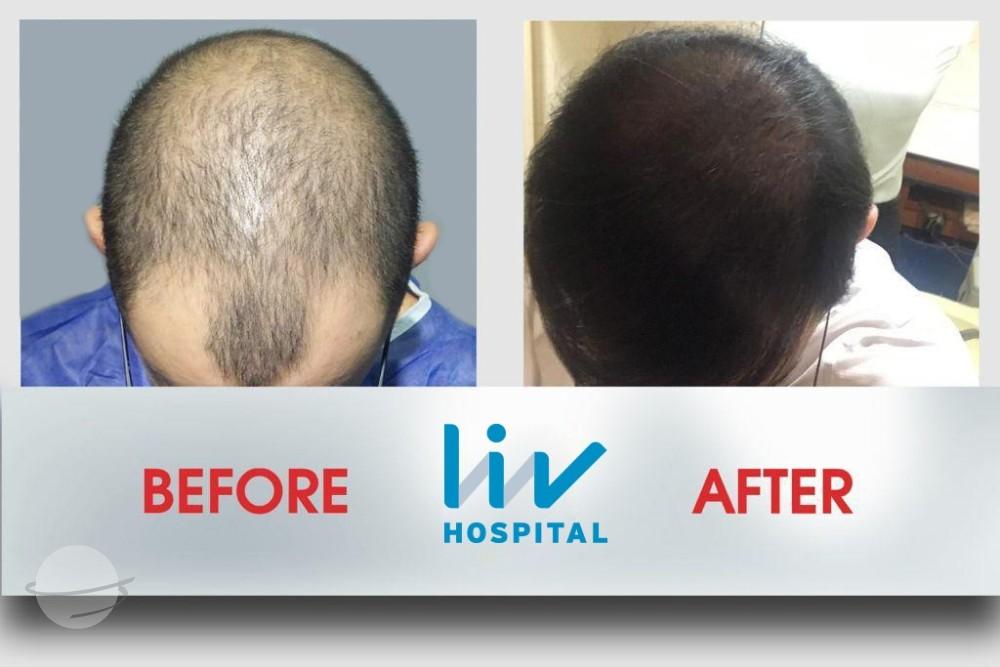 LIV Hospital before and after Hair transplant 4