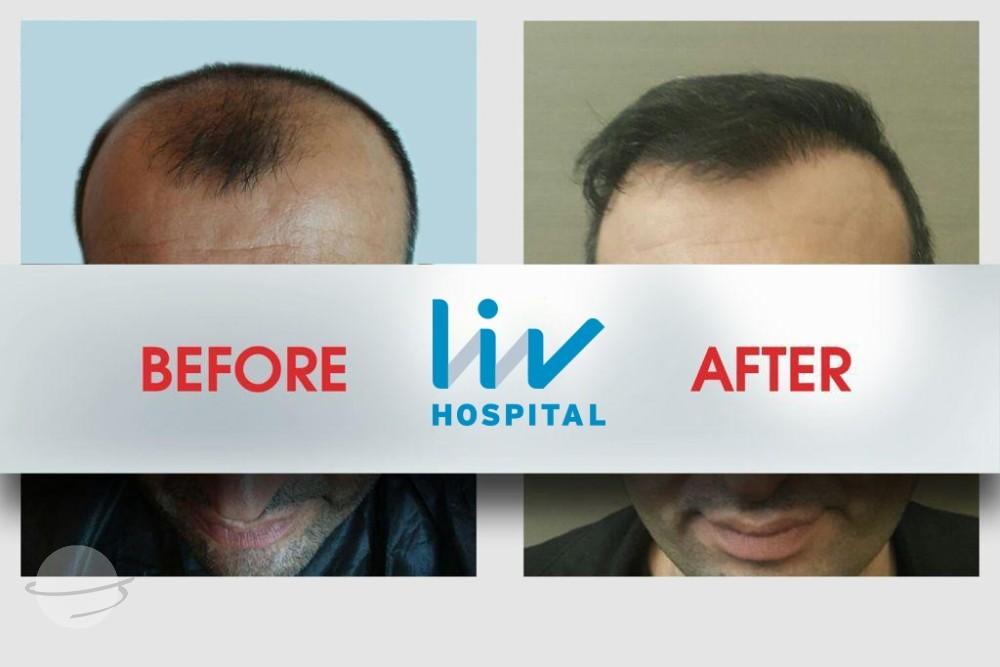 LIV Hospital before and after Hair transplant 5