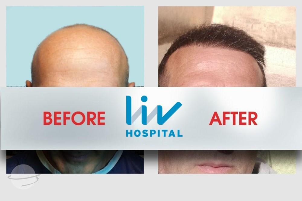 LIV Hospital before and after Hair transplant 6