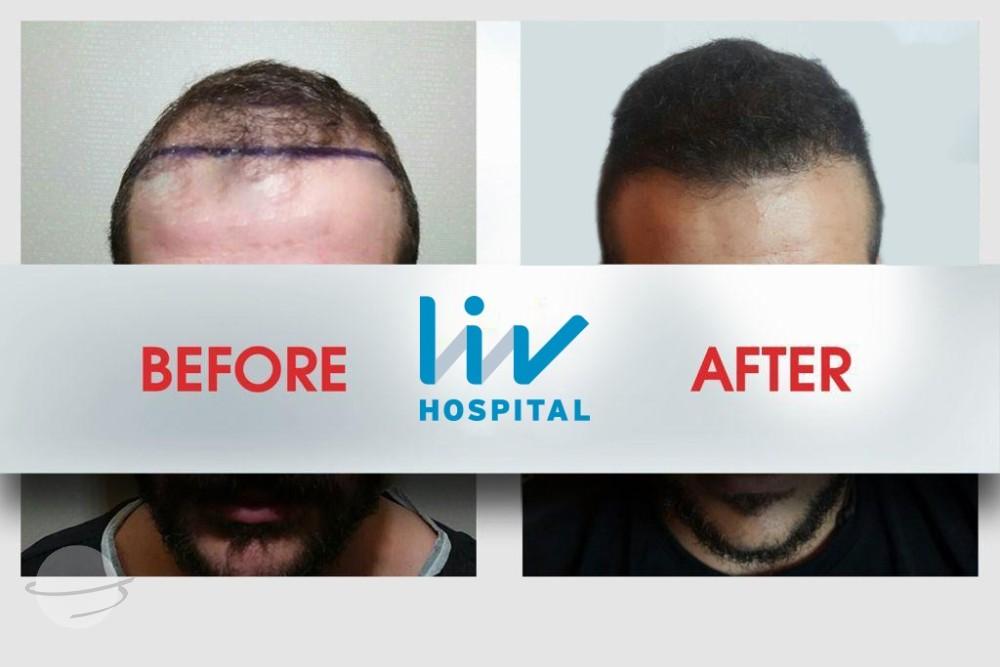 LIV Hospital before and after Hair transplant 9