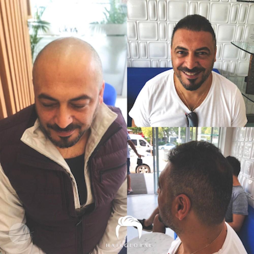 HairGlobal hair results1