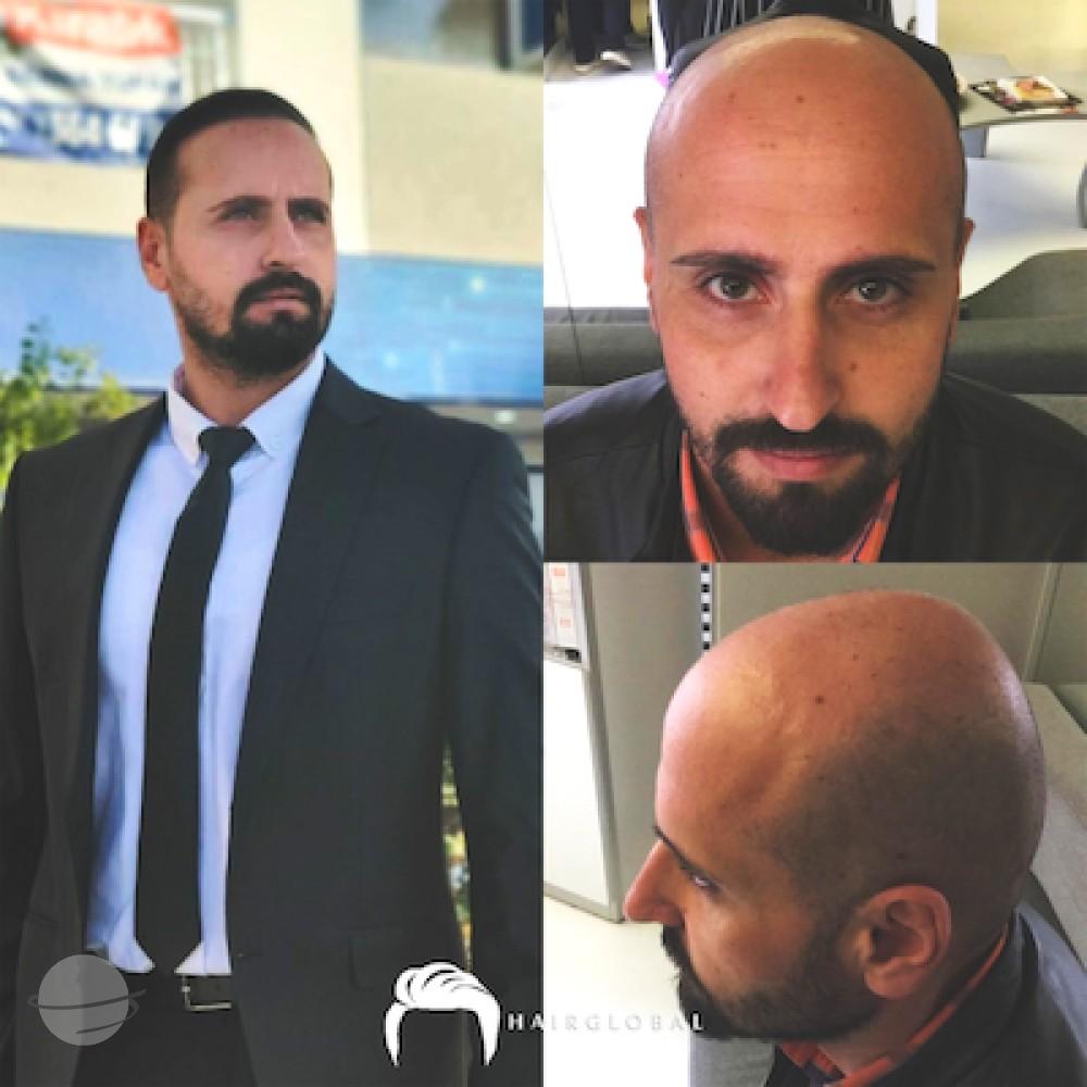 HairGlobal hair results21