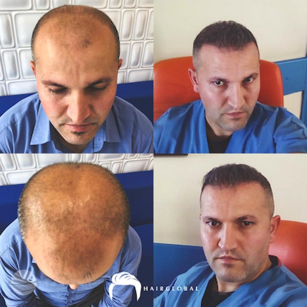 HairGlobal hair results20