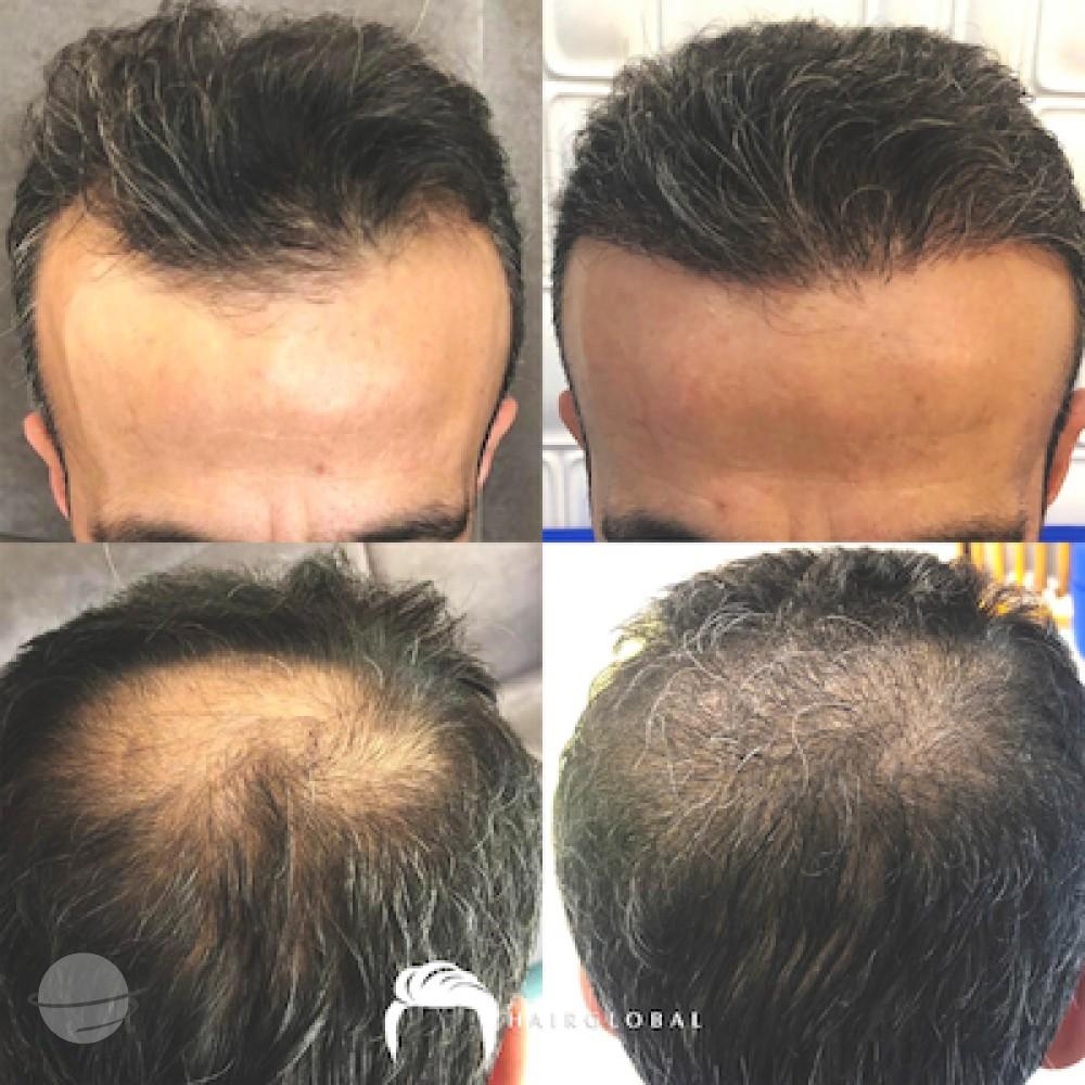 HairGlobal hair results17