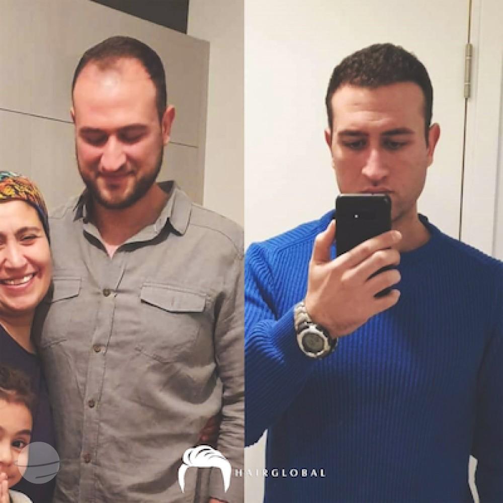 HairGlobal hair results16