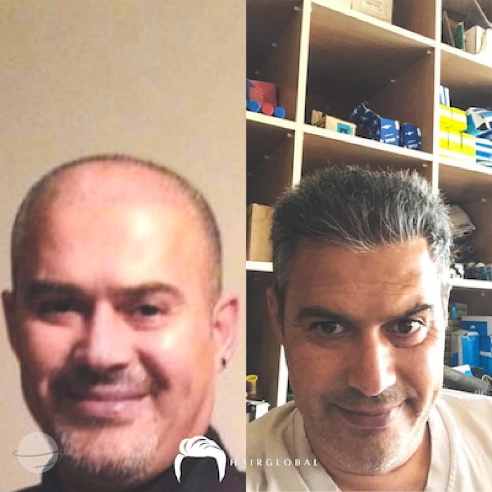 HairGlobal hair results15