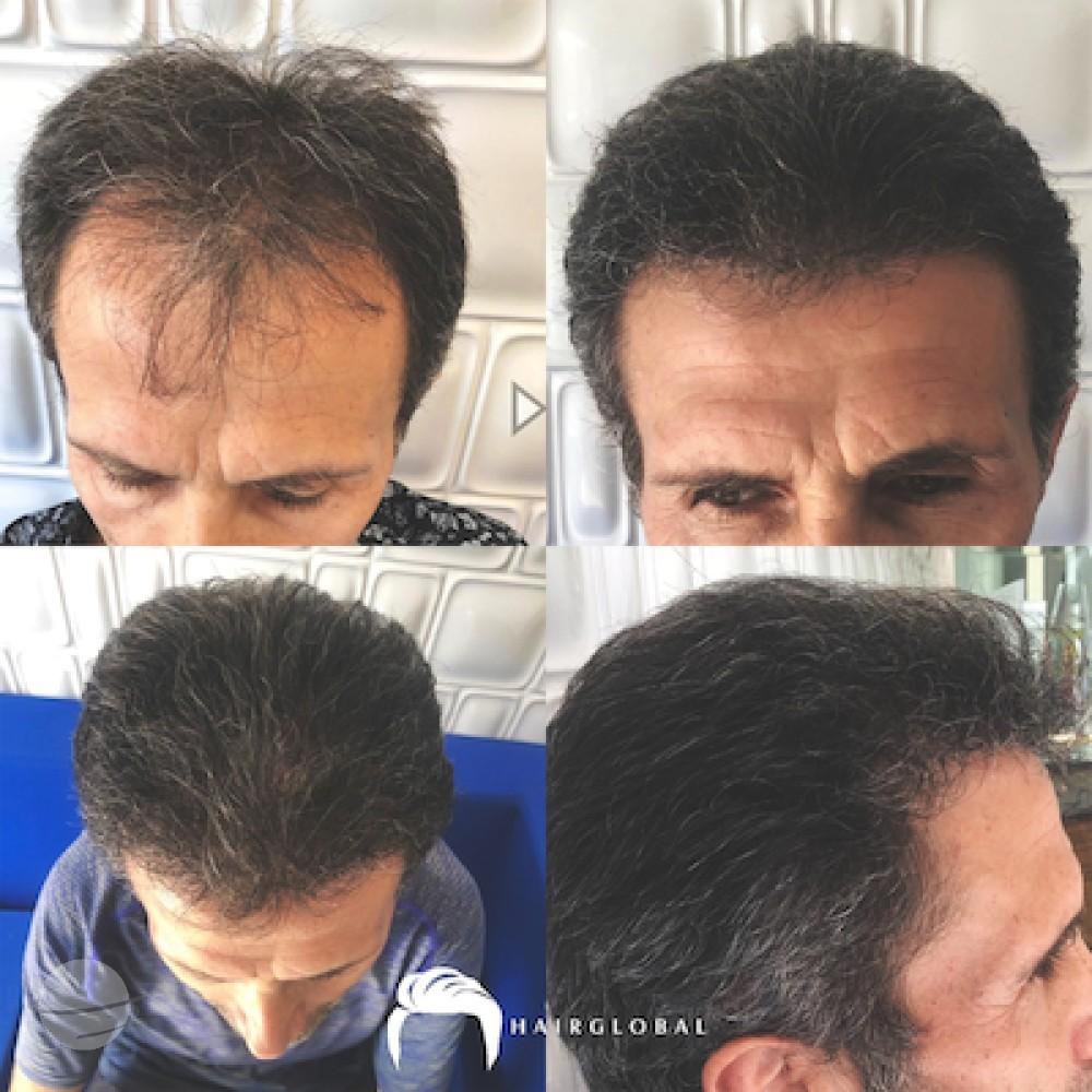 HairGlobal hair results7